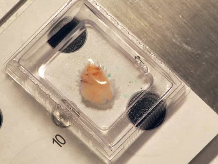 Laser-capture Microdissection of Human Prostatic Epithelium for RNA Analysis