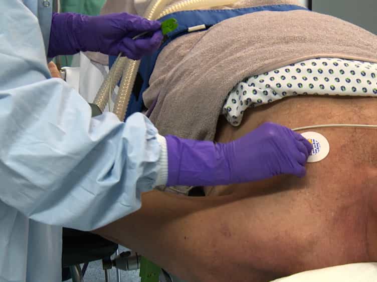 Drug-Induced Sleep Endoscopy DISE with Target Controlled Infusion TCI and Bispectral Analysis in Obstructive Sleep Apnea