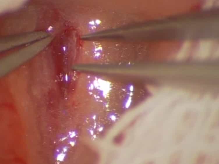 Using the Sleeve Technique in a Mouse Model of Aortic Transplantation - An Instructional Video