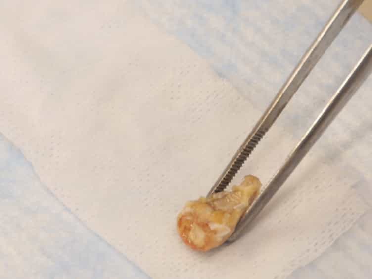 Development of a Direct Pulp-capping Model for the Evaluation of Pulpal Wound Healing and Reparative Dentin Formation in Mice