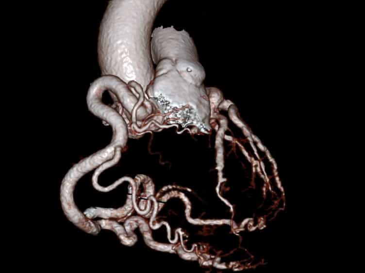 Direct Re-implantation of Left Coronary Artery into the Aorta in Adults with Anomalous Origin of Left Coronary Artery from the Pulmonary Artery ALCAPA