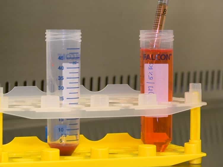 Detection of Residual Donor Erythroid Progenitor Cells after Hematopoietic Stem Cell Transplantation for Patients with Hemoglobinopathies