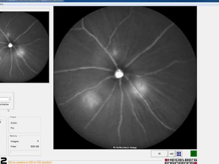 In Vivo Multimodal Imaging and Analysis of Mouse Laser-Induced Choroidal Neovascularization Model