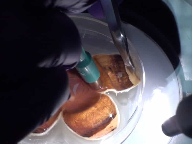 Dissection of Human Retina and RPE-Choroid for Proteomic Analysis