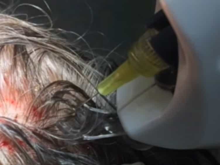 Mechanical and Controlled PRP Injections in Patients Affected by Androgenetic Alopecia