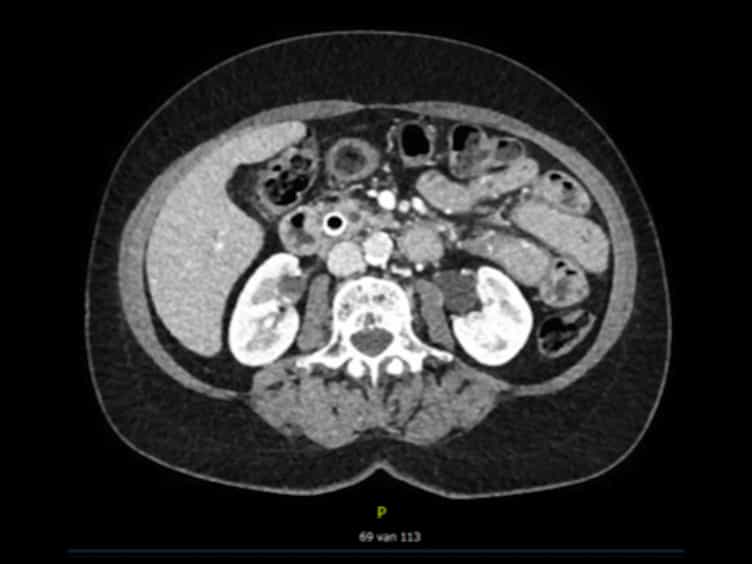 Laparoscopic Pancreatoduodenectomy With Modified Blumgart Pancreaticojejunostomy