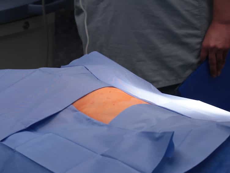 Surgical Swine Model of Chronic Cardiac Ischemia Treated by Off-Pump Coronary Artery Bypass Graft Surgery