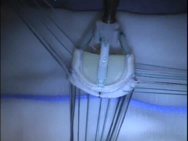 Technique and Patient Selection Criteria of Right Anterior Mini-Thoracotomy for Minimal Access Aortic Valve Replacement