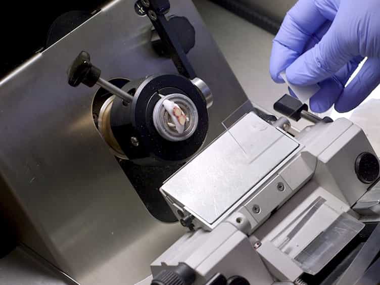 Spatial Quantification of Drugs in Pulmonary Tuberculosis Lesions by Laser Capture Microdissection Liquid Chromatography Mass Spectrometry LCM-LC/MS