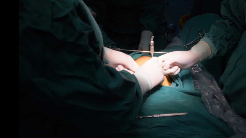 Introduction of Intracapsular Rotary-cut Procedures IRCP: A Modified Hysteromyomectomy Procedures Facilitating Fertility Preservation