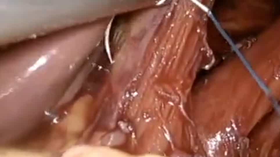 Laparoscopic Repair of Para-Esophageal Hernia Using Absorbable Biosynthetic Mesh