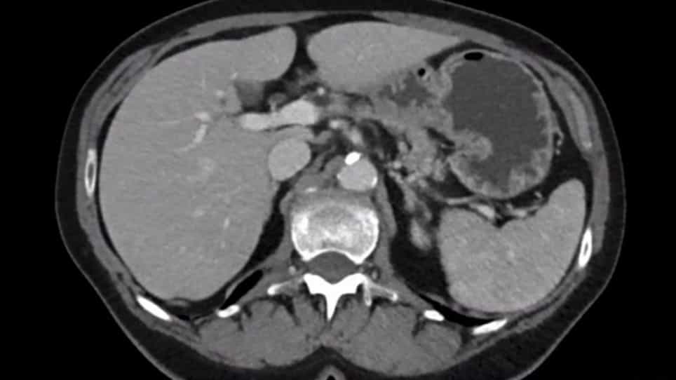Laparoscopic Radical Left Pancreatectomy for Pancreatic Cancer: Surgical Strategy and Technique Video