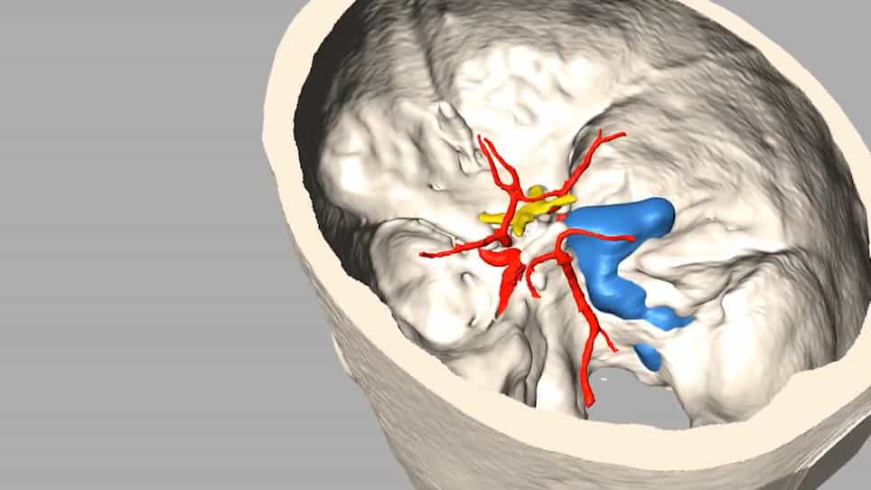 Multicolor 3D Printing of Complex Intracranial Tumors in Neurosurgery