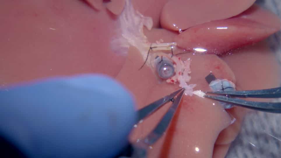 Reduced Complications after Arterial Reconnection in a Rat Model of Orthotopic Liver Transplantation