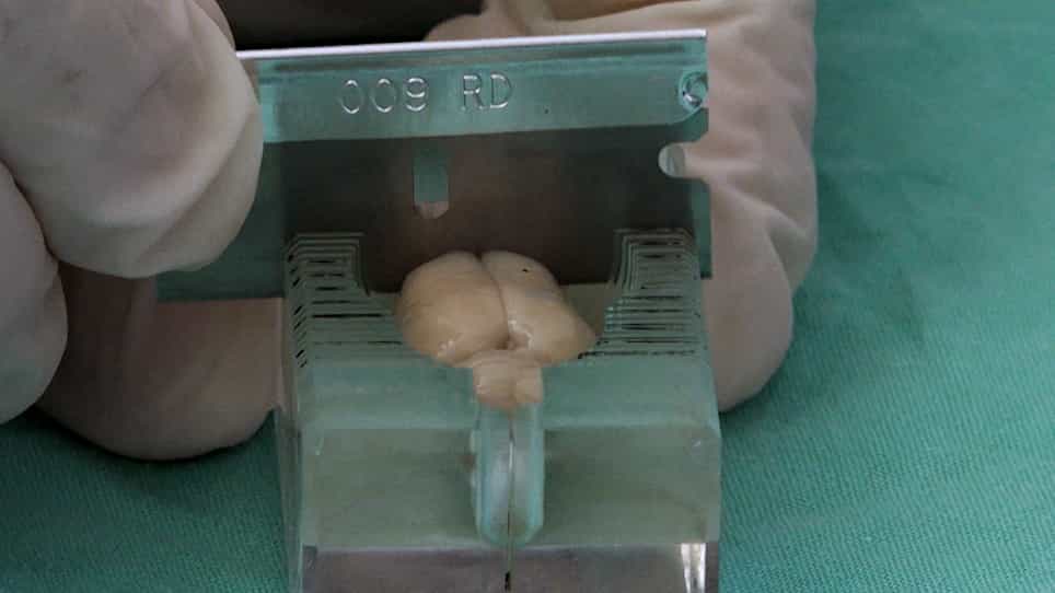 Measuring Post-Stroke Cerebral Edema, Infarct Zone and Blood-Brain Barrier Breakdown in a Single Set of Rodent Brain Samples