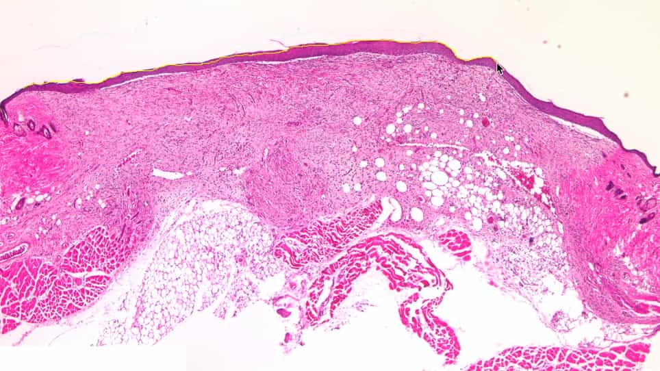 Murine Excisional Wound Healing Model and Histological Morphometric Wound Analysis