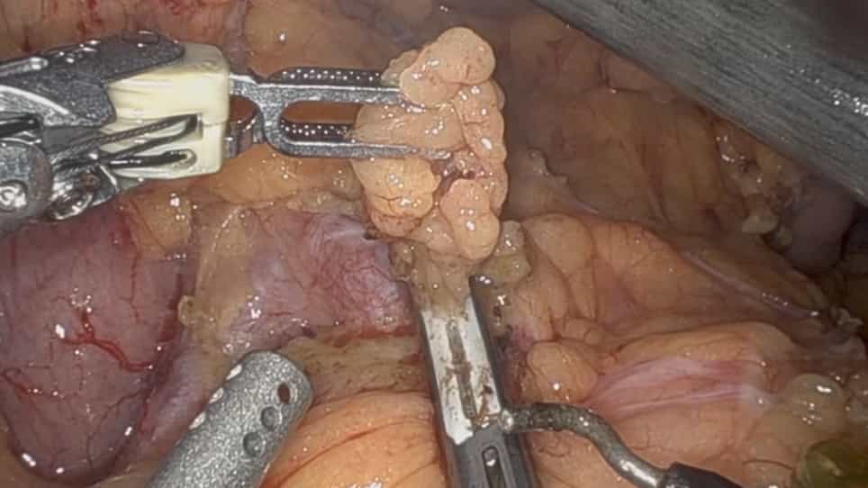 Robot Assisted Distal Pancreatectomy with Celiac Axis Resection DP-CAR for Pancreatic Cancer: Surgical Planning and Technique