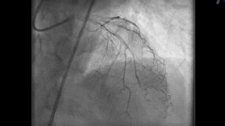 Acetylcholine Re-Challenge After Intracoronary Nitroglycerine Administration