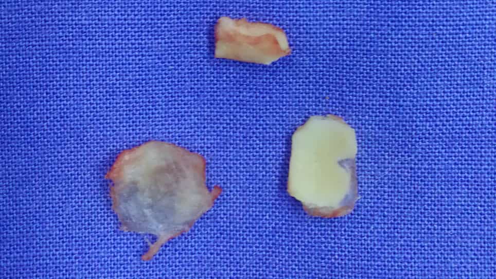 Endaural Endoscopic Atticoantrotomy Retrograde Mastoidectomy using a Constant Suction Bone-drilling Technique