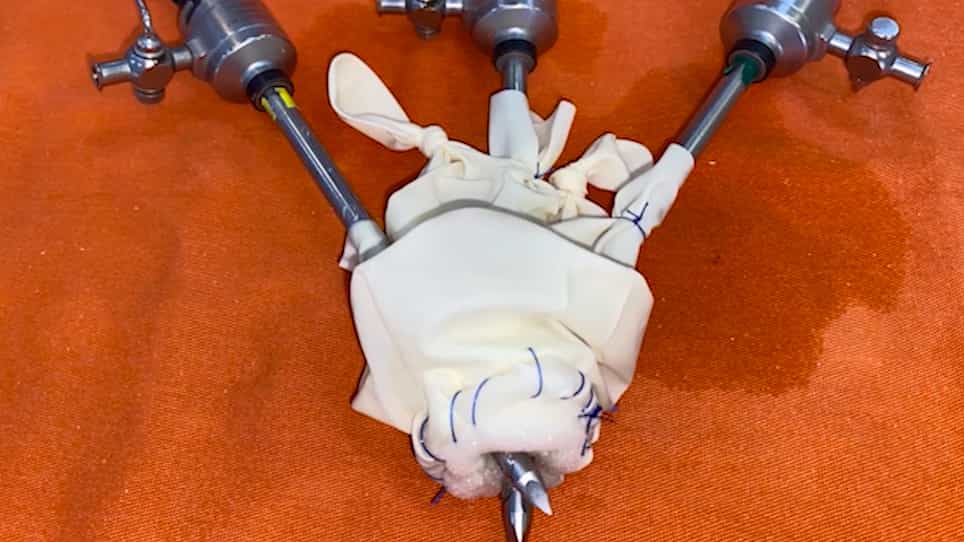 Low-Cost Single-Port LoCoSP Device for a Transcervical Approach in Minimally Invasive Transhiatal Esophagectomy