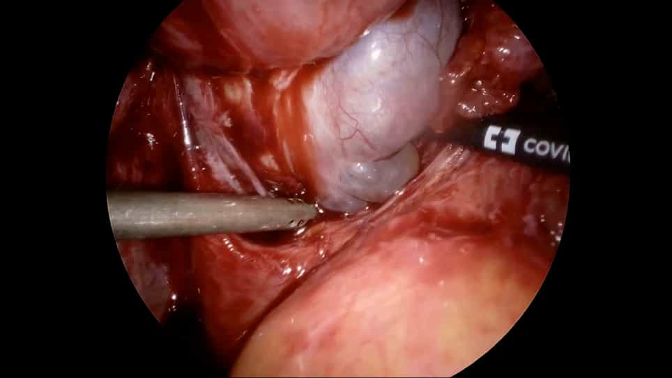 Surgical Techniques to Optimize Ovarian Reserve during Laparoscopic Cystectomy for Ovarian Endometrioma