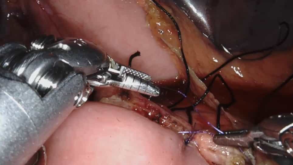 Robotic Central Pancreatectomy with Roux-en-Y Pancreaticojejunostomy