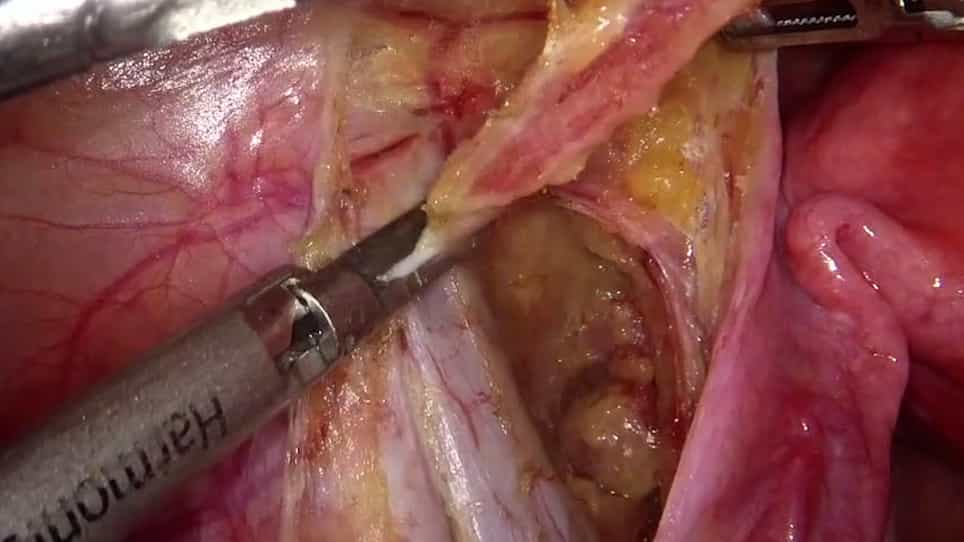 Sentinel Lymph Node Mapping and Biopsy for Endometrial Cancer at Early Stage with Laparoscopy