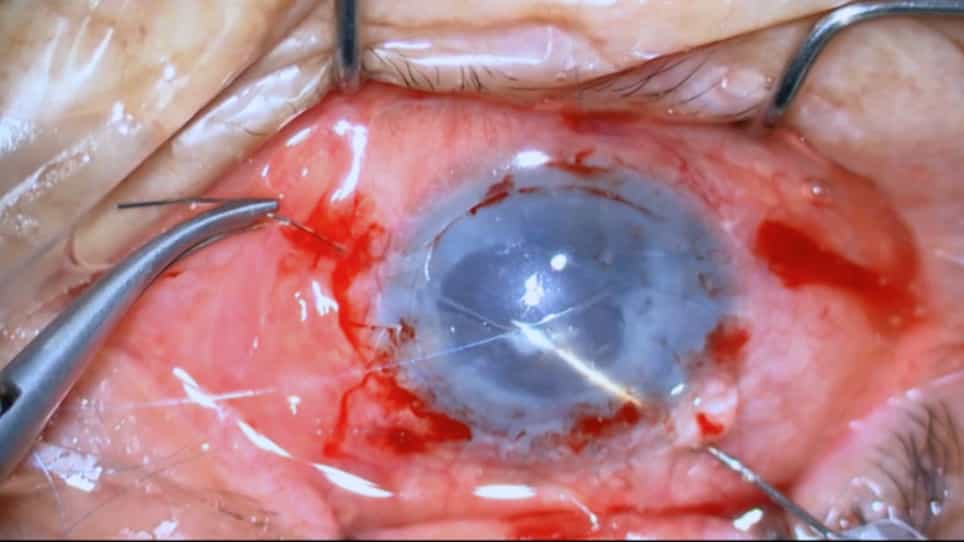 Iris Fixation via External Pentagram Suturing