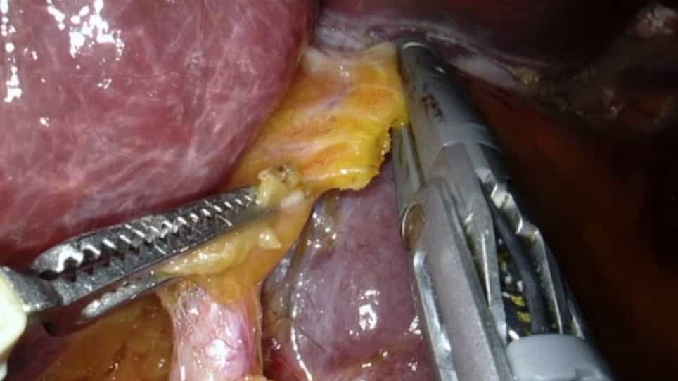 Robotic Left Hepatectomy using Indocyanine Green Fluorescence Imaging for an Intrahepatic Complex Biliary Cyst