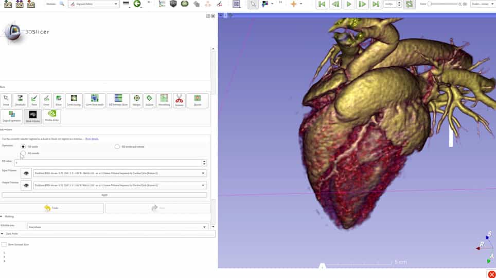 Four-Dimensional Computed Tomography-Guided Valve Sizing for Transcatheter Pulmonary Valve Replacement