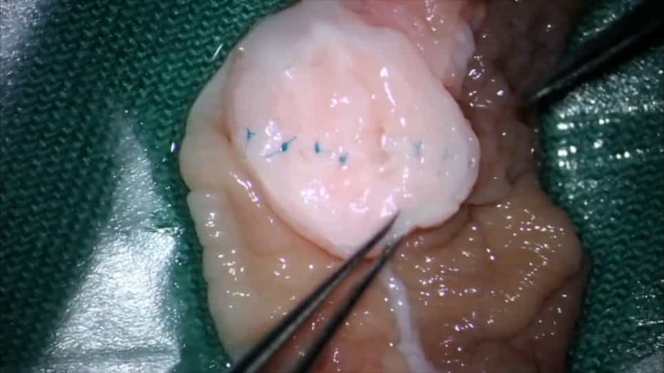 Microscopic Replantation of Penile Glans Amputation Due to Circumcision
