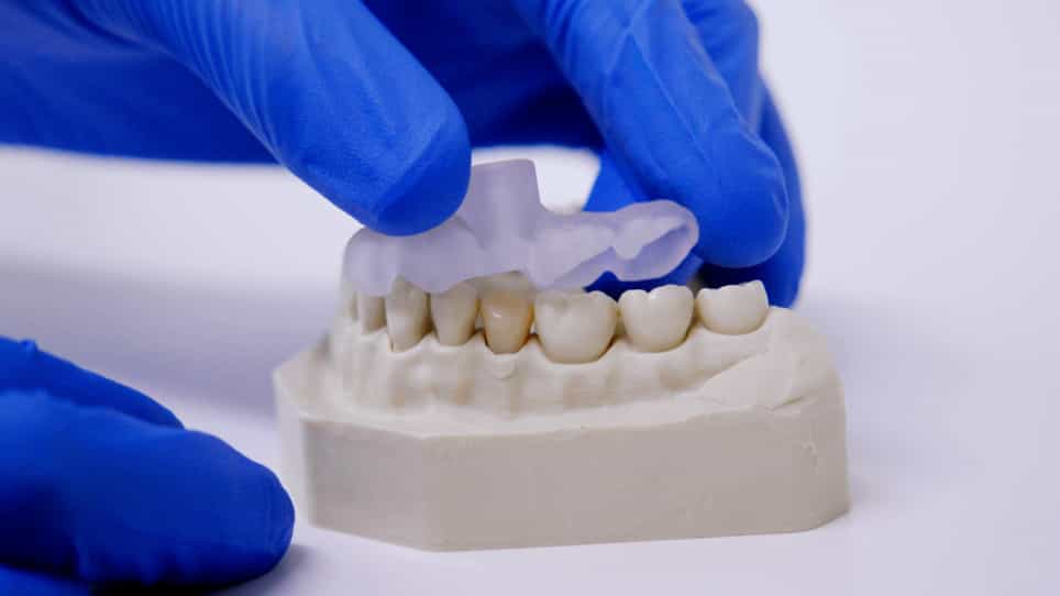 Guided Endodontics: Three-Dimensional Planning and Template-Aided Preparation of Endodontic Access Cavities