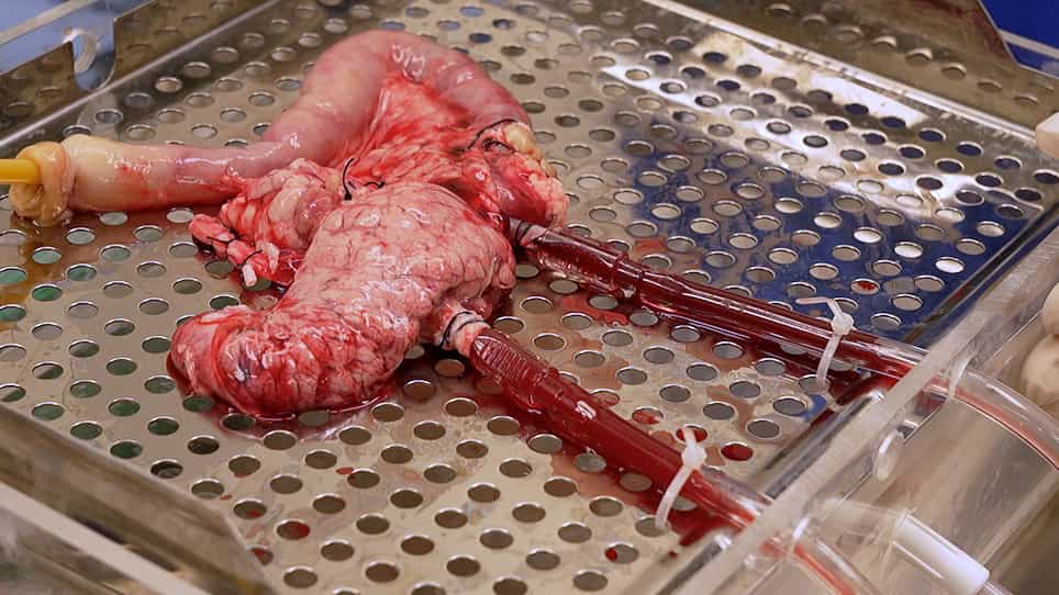 Normothermic Ex Vivo Pancreas Perfusion for the Preservation of Pancreas Allografts before Transplantation
