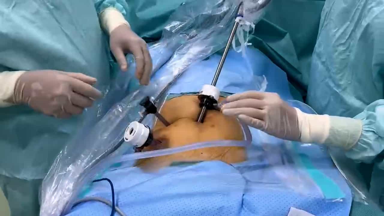 Clinical Application of Single-Surgeon, Three-Port, Laparoscopic Resection for Colorectal Cancer with Natural Orifice Specimen Extraction