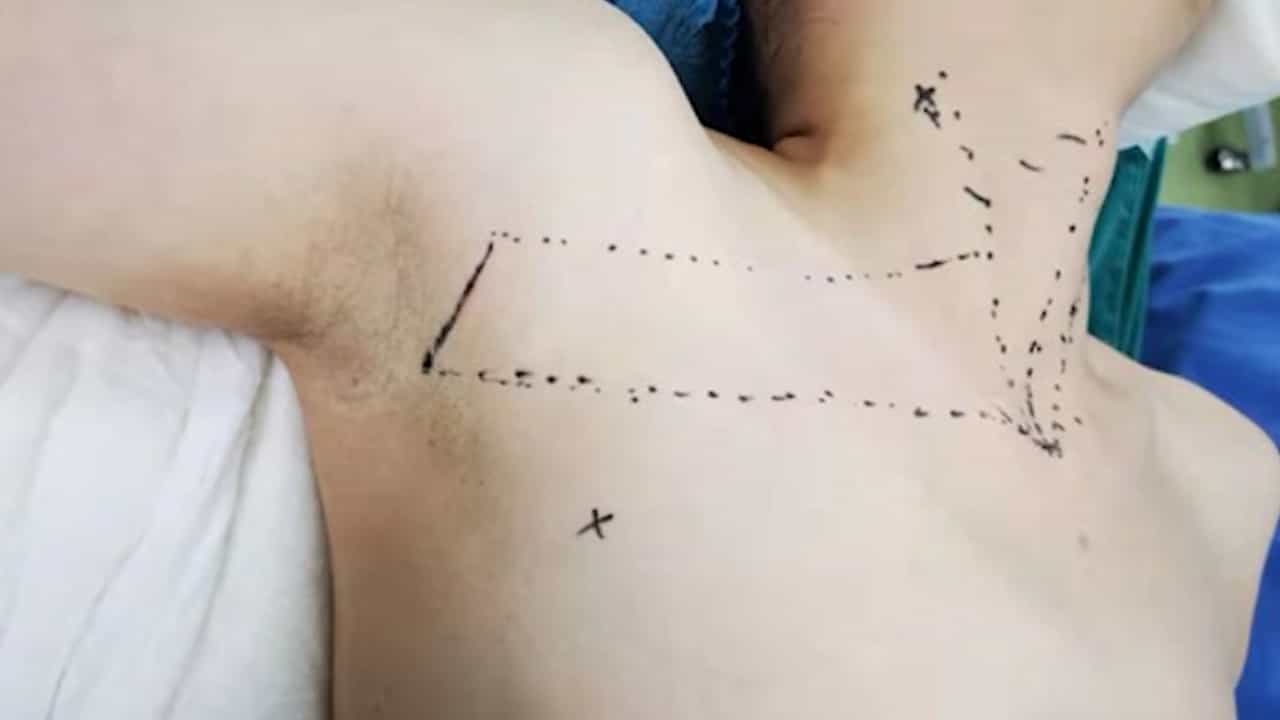 Gasless Endoscopic Thyroidectomy via the Trans-Axillary Approach