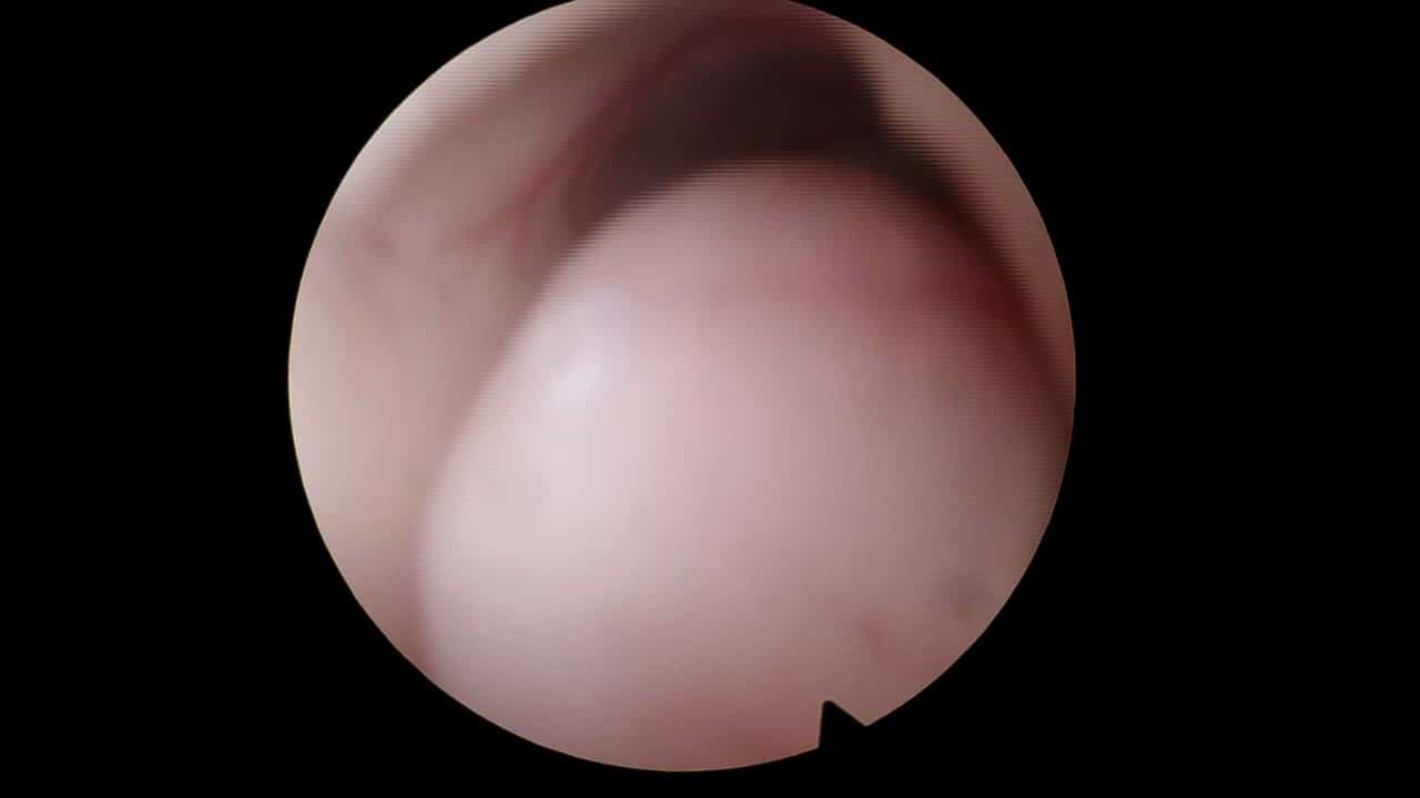 Full-Endoscopic Surgery for Hypothalamic Hamartoma Resection