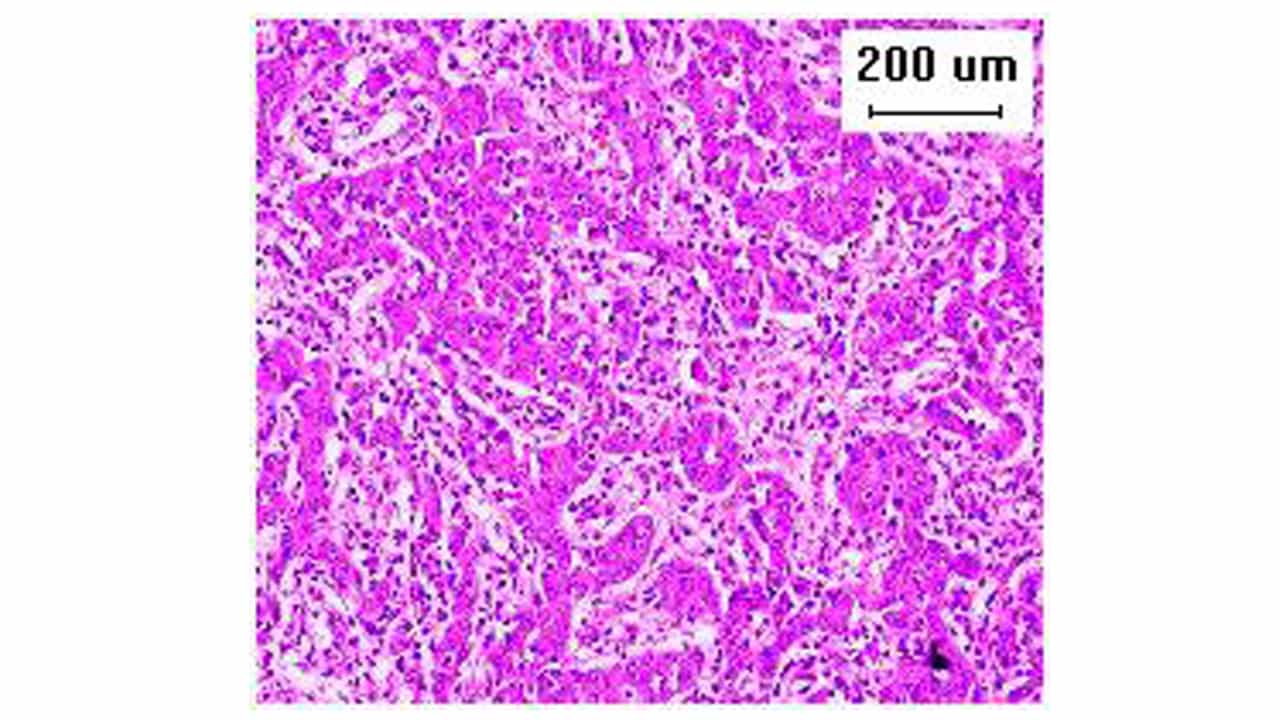 Fluorescent Laparoscopic Central Hepatectomy for Liver Cancer Using Indocyanine Green Negative Staining
