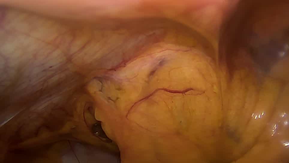 Laparoscopic Common Bile Duct Exploration in Patients with a Previous History of Biliary Tract Surgery