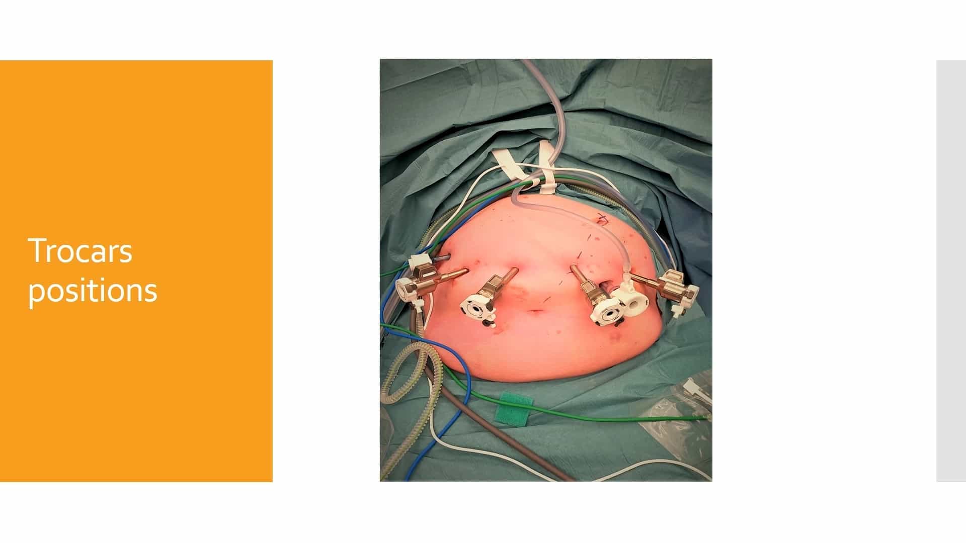 Robotic Spleen-Preserving Distal Pancreatectomy: The Warshaw and Kimura Techniques