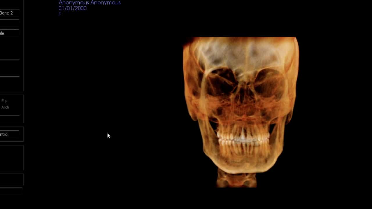 Author Spotlight: Three-Dimensional Cephalometric Landmark Annotation Demonstration on Human Cone Beam Computed Tomography Scans