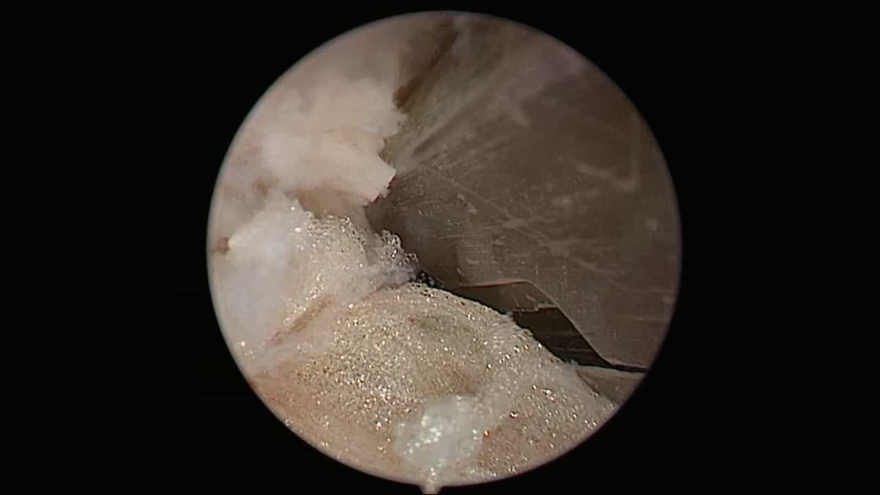 Author Spotlight: Unveiling the Potential of TUBE Technique in Spinal Surgery