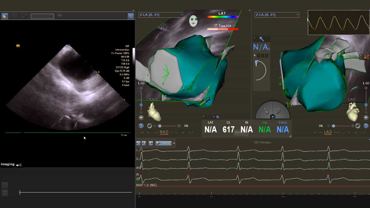Three-Dimensional Modeling of the Left Atrium and Pulmonary Veins with a Precise Intracardiac Echocardiography Approach