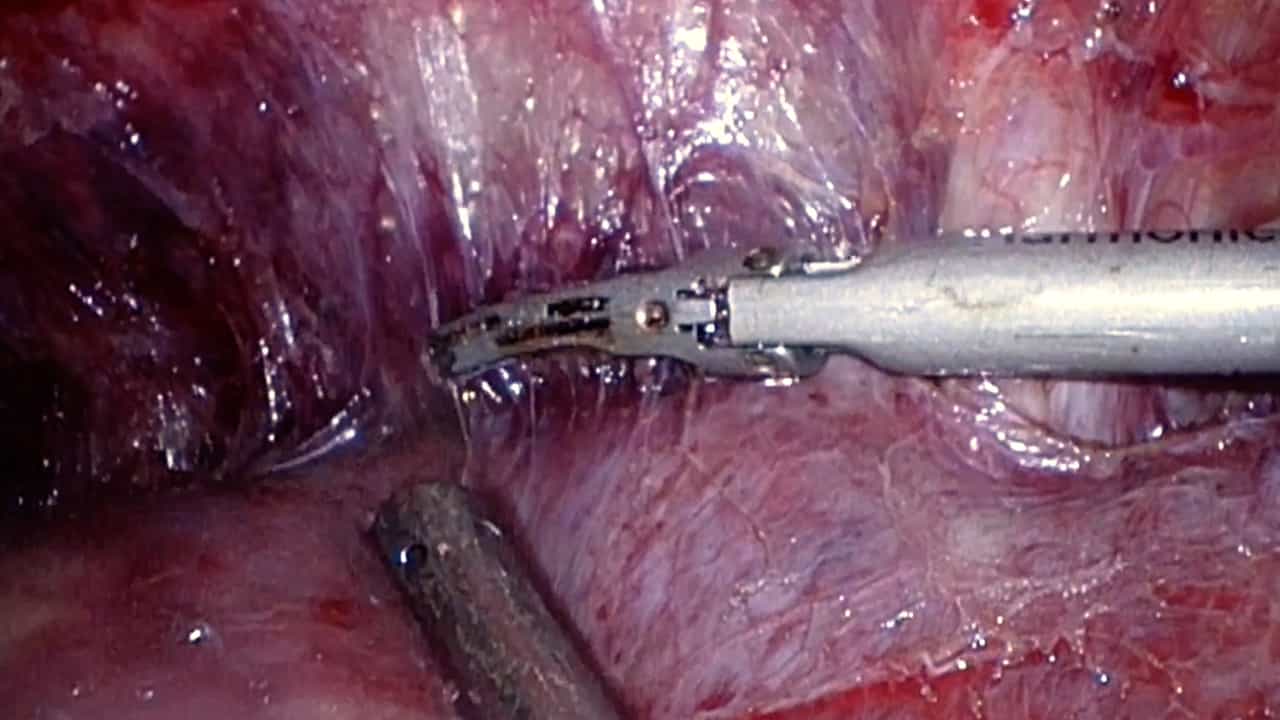 Techniques of Laparoscopic Right Posterior Sectionectomy: Glissonian Approach and a Parenchymal Transection Technique