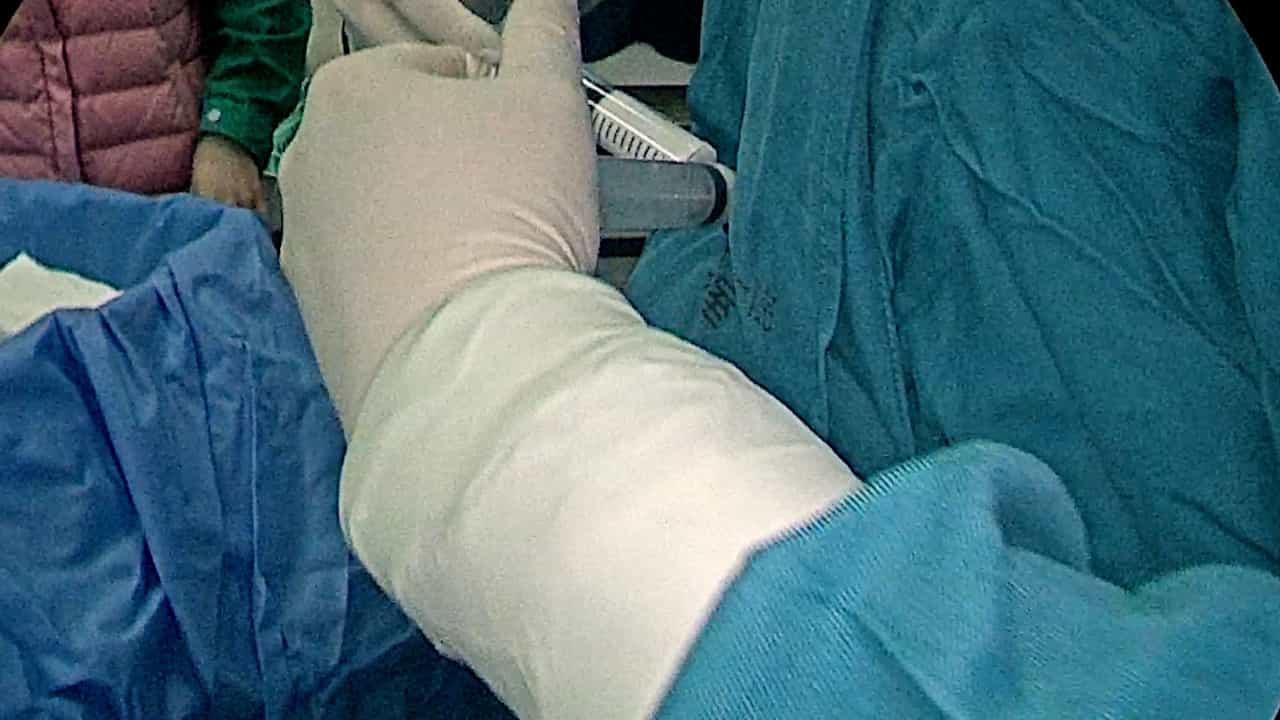 Combination of High Ligation and Intraoperative Embolization using Polidocanol for Treatment of Varicoceles