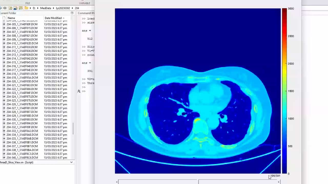 Author Spotlight: Advancing 3D Modeling for Enhanced Diagnosis and Treatment of Pulmonary Nodules in Early-Stage Lung Cancer