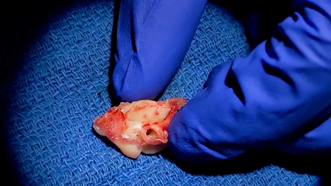 Author Spotlight: Extraction of Guinea Pig Round Window Membrane to Facilitate Inner Ear Drug Delivery Research