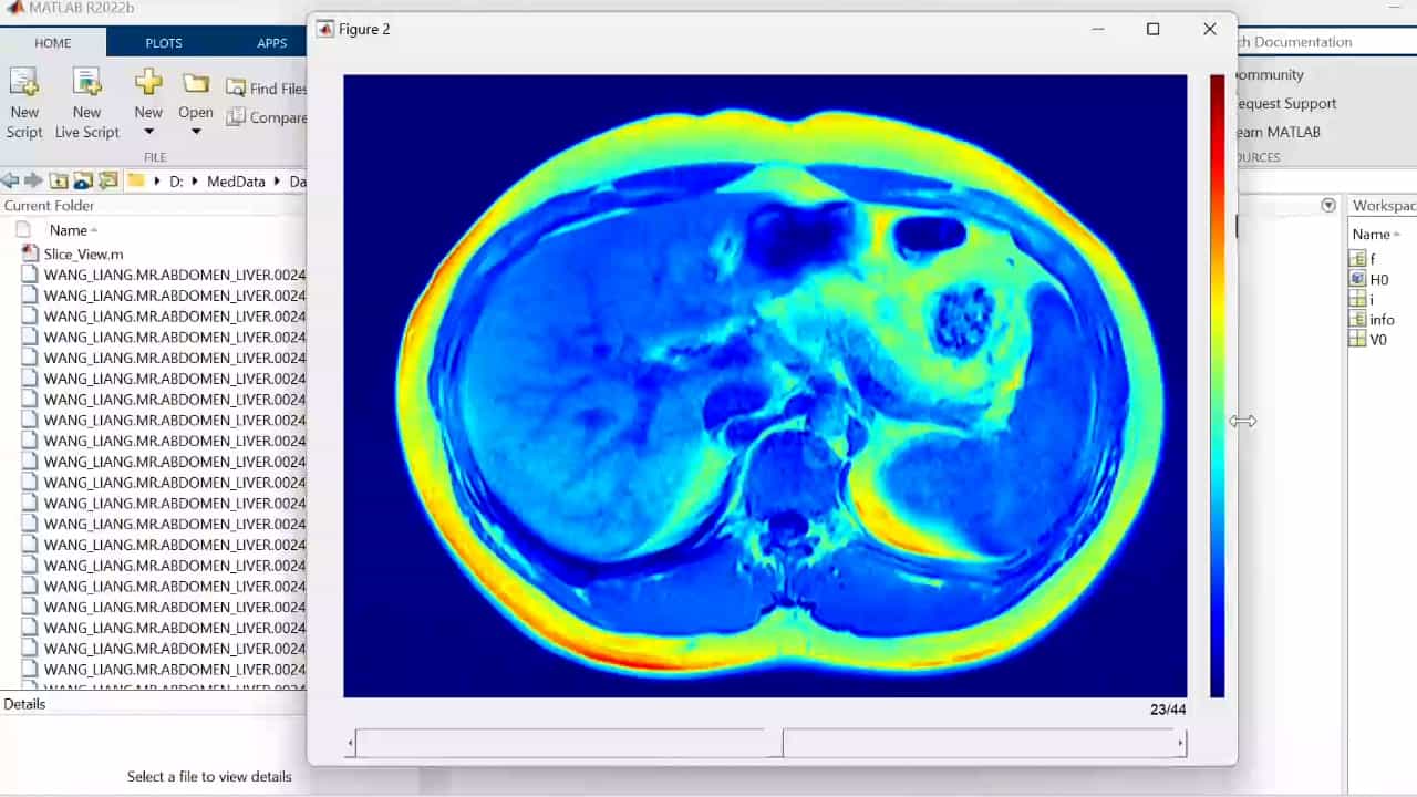 Author Spotlight: A Non-Invasive Tool to Assess and Differentiate Fat Patterns in Liver Using 3D Dixon MRI