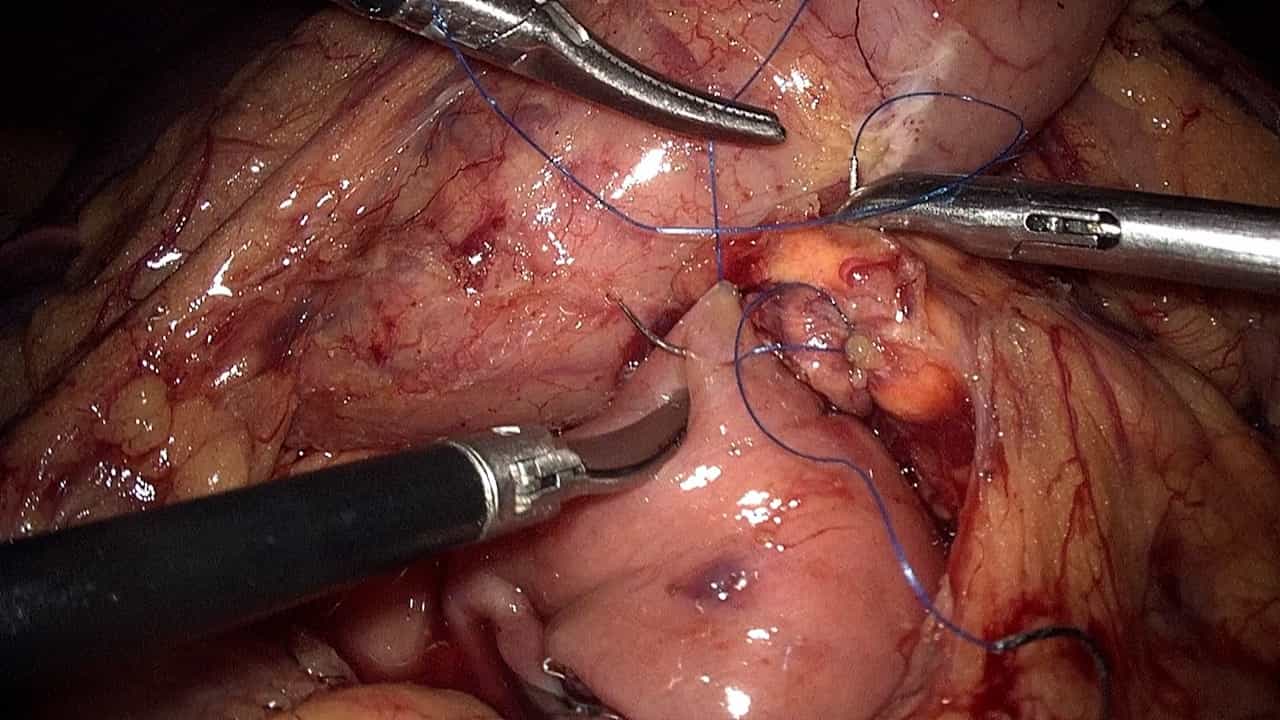 Laparoscopic Duodenum-Preserving Pancreatic Head Resection via Inferior Infracolic Approach: A Surgical Approach for Benign Lesions