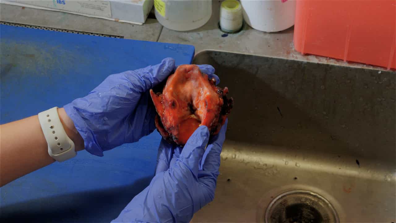 Author Spotlight: 3D Scanning and Augmented Reality for Enhanced Cancer Surgery Communication