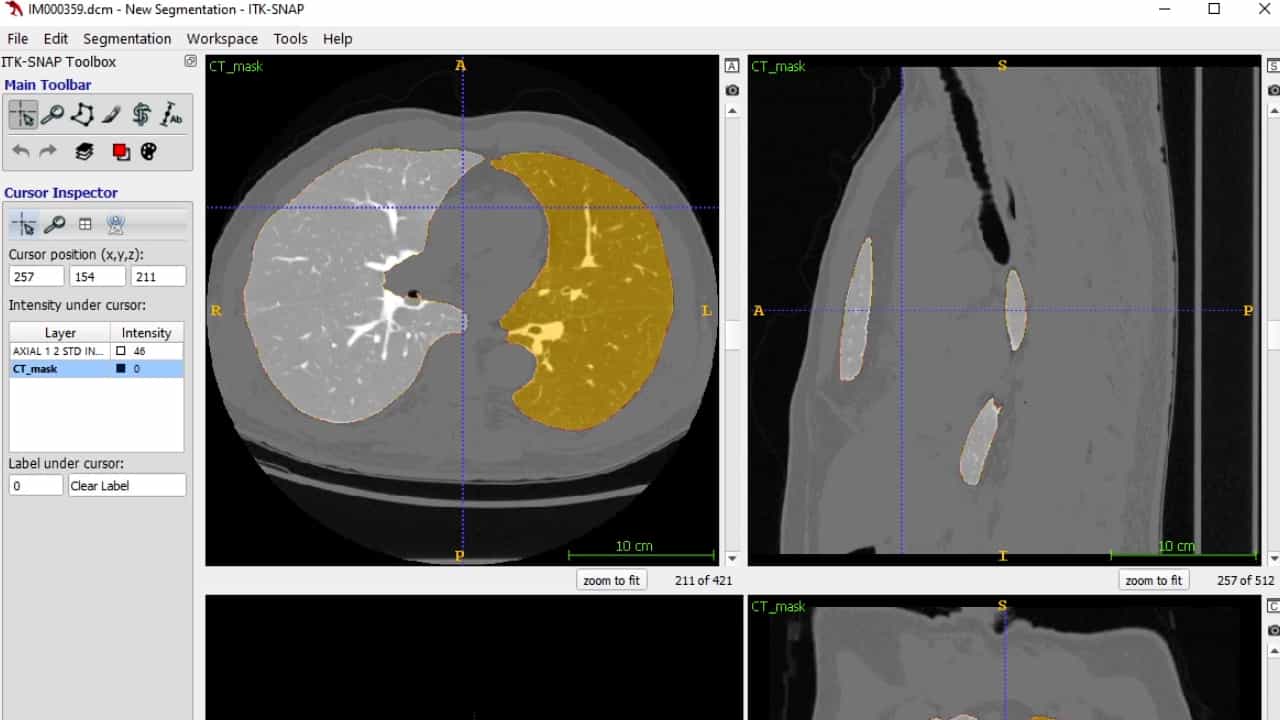 Multi-modal Pulmonary Imaging: Using Complementary Information from CT and Hyperpolarized 129Xe MRI to Evaluate Lung Structure-Function